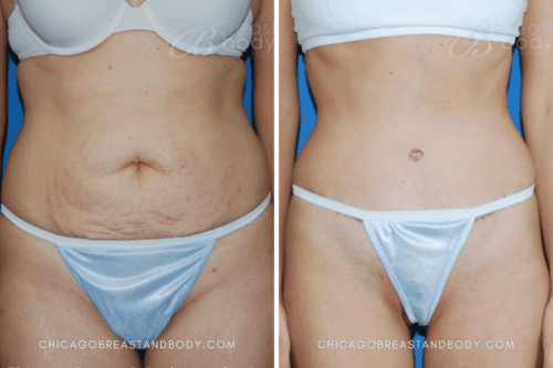 189 Tummy Tuck Dr. Anh-Tuan Truong Chicago 6mos