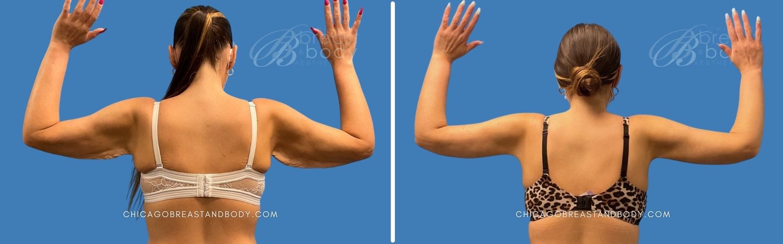 arm lift before after photo chicago breast and body by Dr. Kevin Lin 1893195