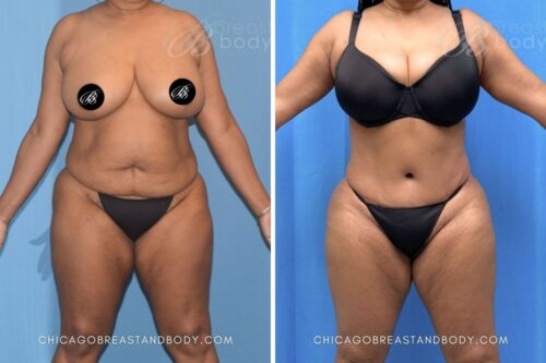 1928231-Tummy-Tuck-By-Dr.-Anh-Tuan-Truong-12Mo