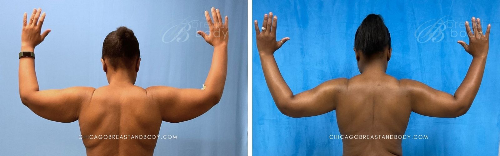 Arm Lift Before After Photo Chicago Breast And Body 1996527