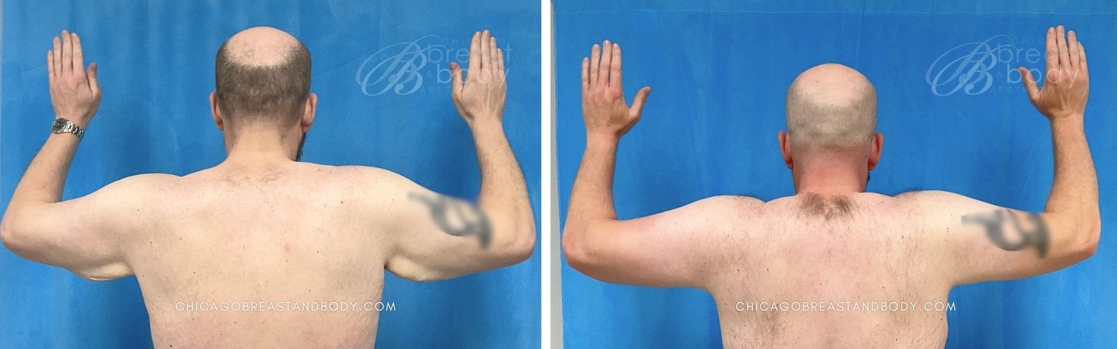 male arm lift before after photos chicago breast and body dr kevin lin 2032827