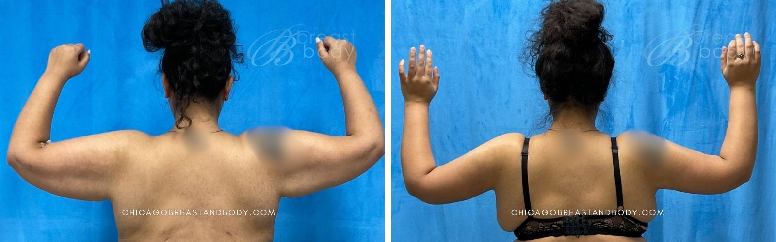 arm lift before after photo chicago breast and body 2115211