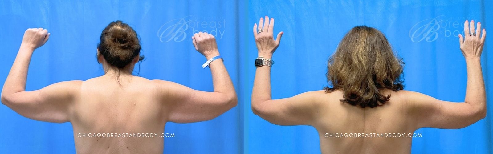 arm lift before after photo chicago breast and body 2182140