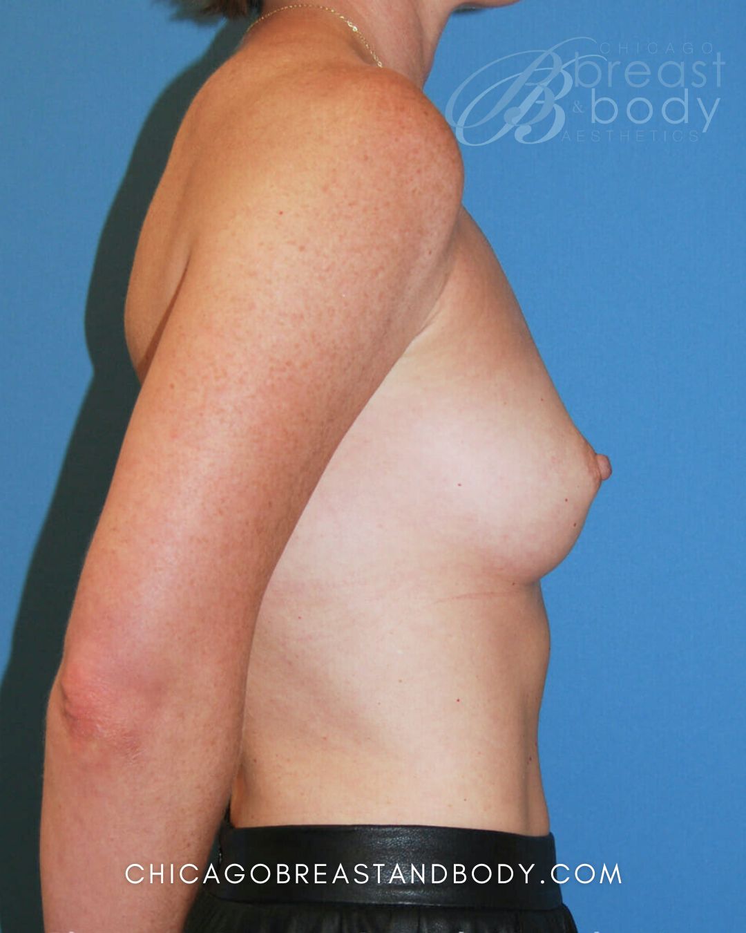 Breast Augmentation before photo 3, case #231, Dr. Anh-Tuan Truong, Chicago Breast & Body