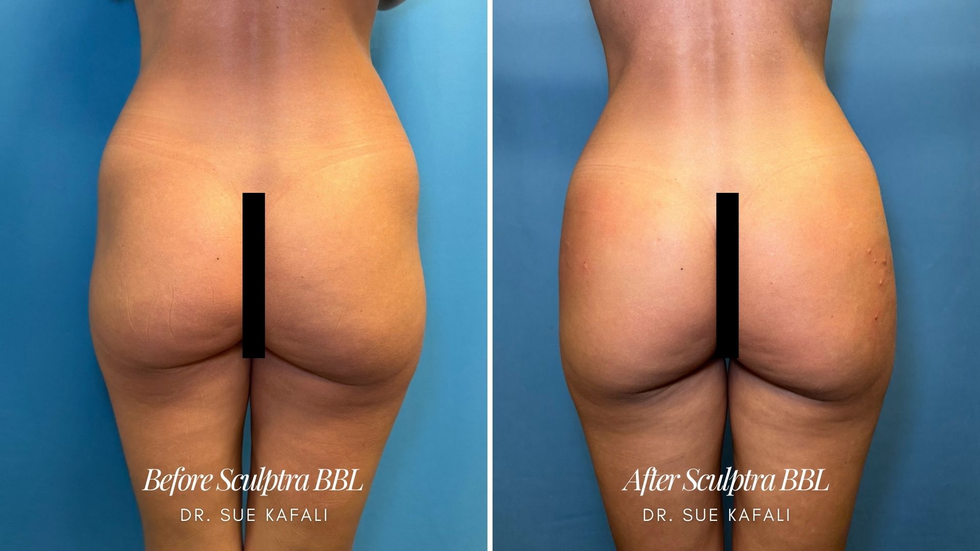 2326305 Sculptra Before Dr. Kafali Femsculpt