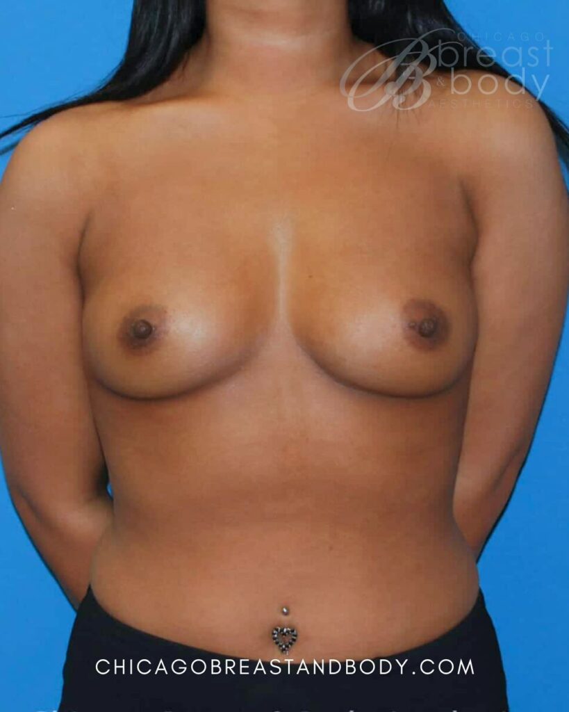 234 Breast Augmentation and Tummy Tuck by Dr. Anh Tuan Truong
