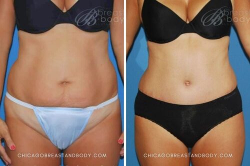 24 Tummy Tuck Dr. Anh-Tuan Truong Chicago 6mos