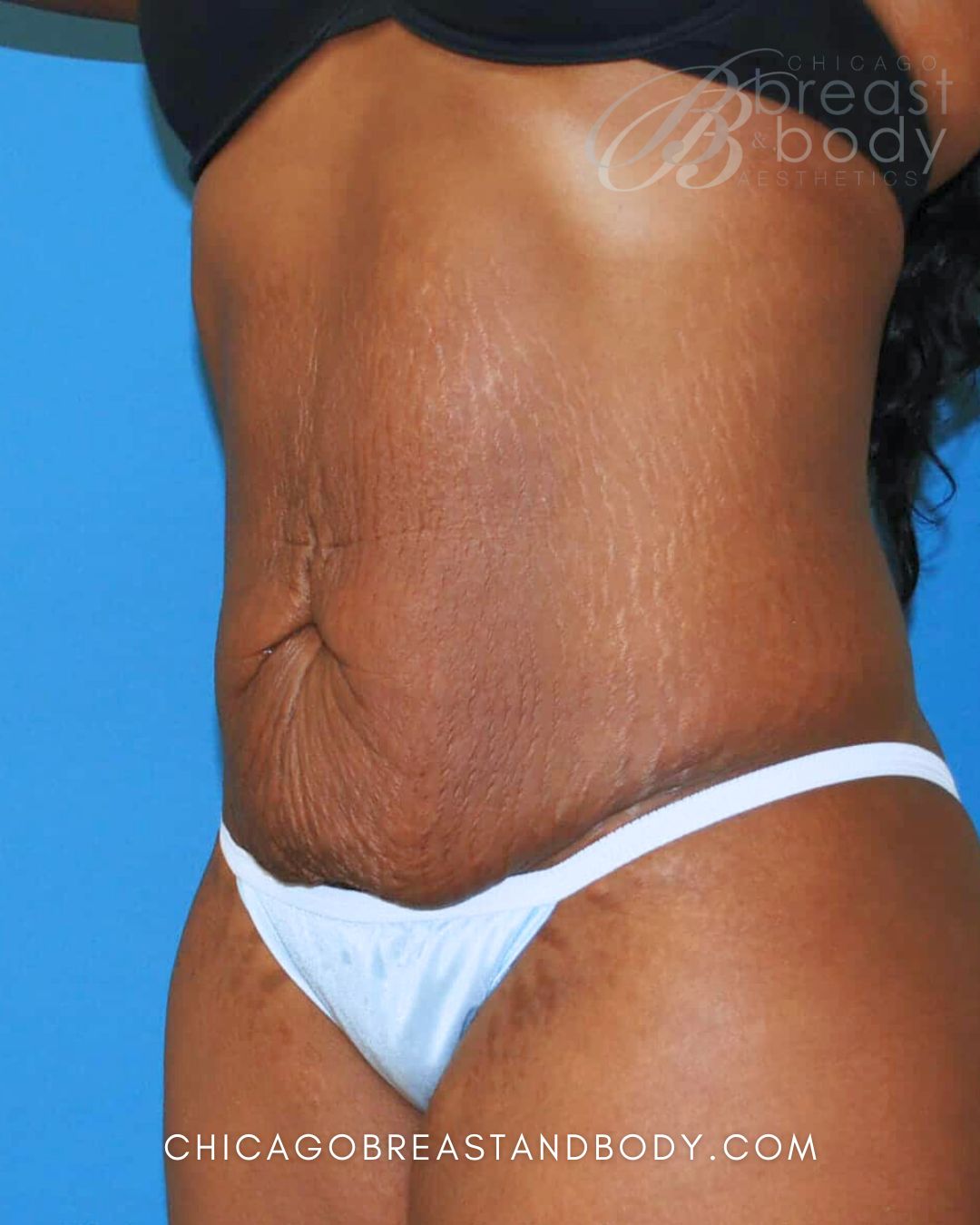 Abdominoplasty (Tummy Tuck) before photo 2, case #250, Dr. Anh-Tuan Truong, Chicago Breast & Body