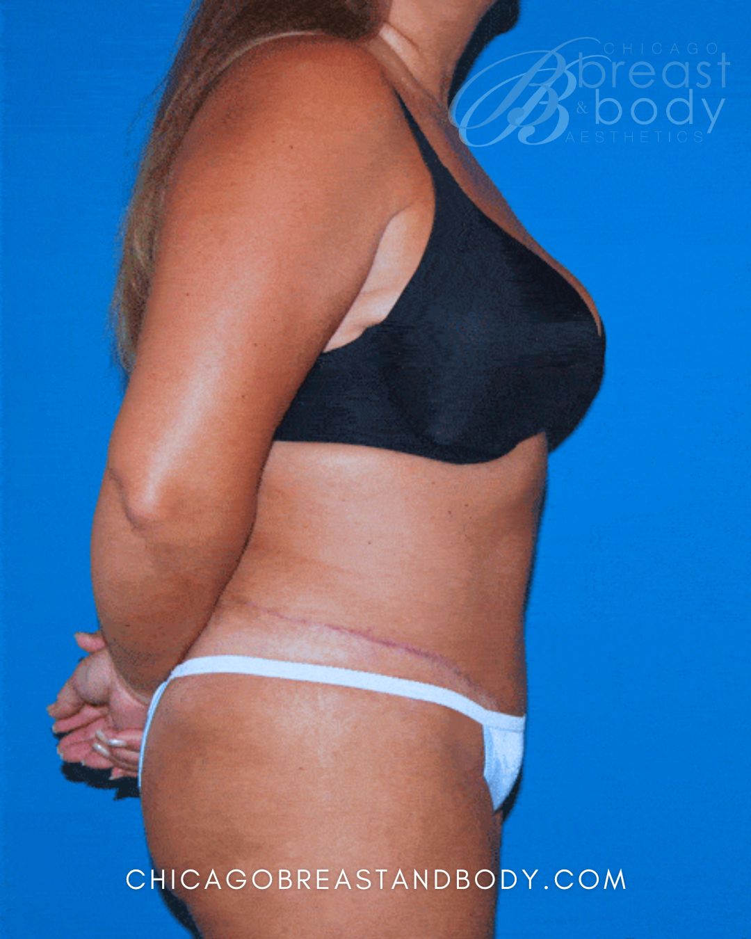 Abdominoplasty (Tummy Tuck), Lipo 360, Lipoabdominoplasty (Tummy Tuck with Liposuction) after photo 3, case #30, Dr. Anh-Tuan Truong, Chicago Breast & Body