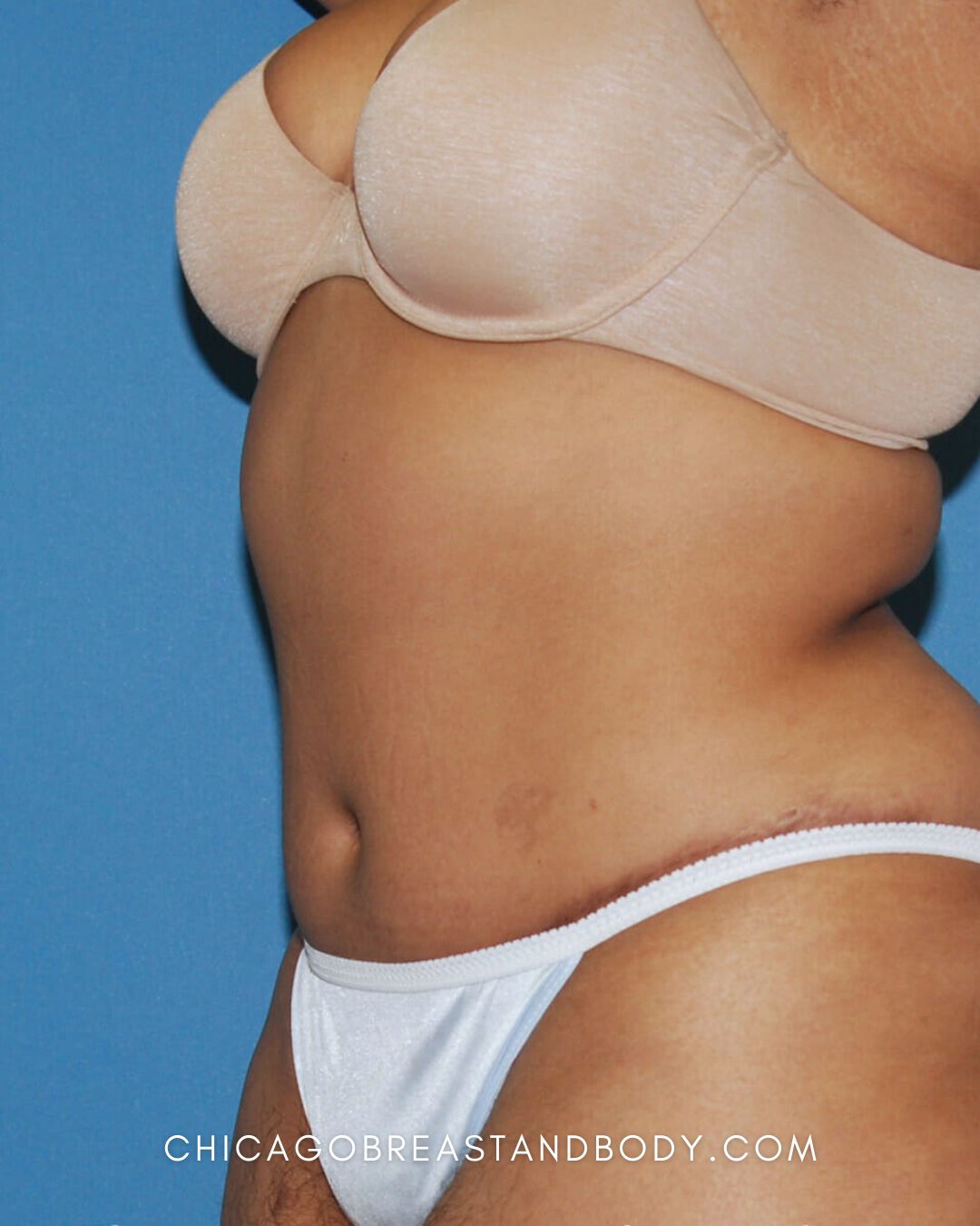 Abdominoplasty (Tummy Tuck) after photo 2, case #336, Dr. Anh-Tuan Truong, Chicago Breast & Body