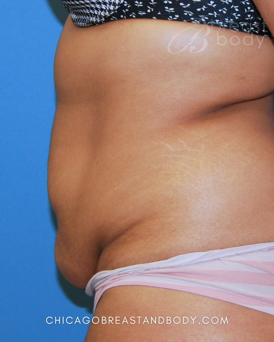 Abdominoplasty (Tummy Tuck) before photo 3, case #336, Dr. Anh-Tuan Truong, Chicago Breast & Body