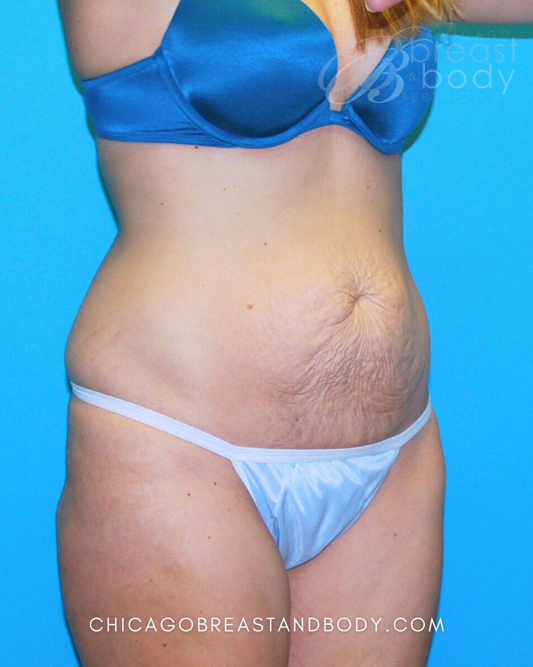 Abdominoplasty (Tummy Tuck) before photo 4, case #338, Dr. Anh-Tuan Truong, Chicago Breast & Body