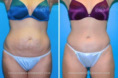 338 Tummy Tuck Dr. Anh-Tuan Truong Chicago