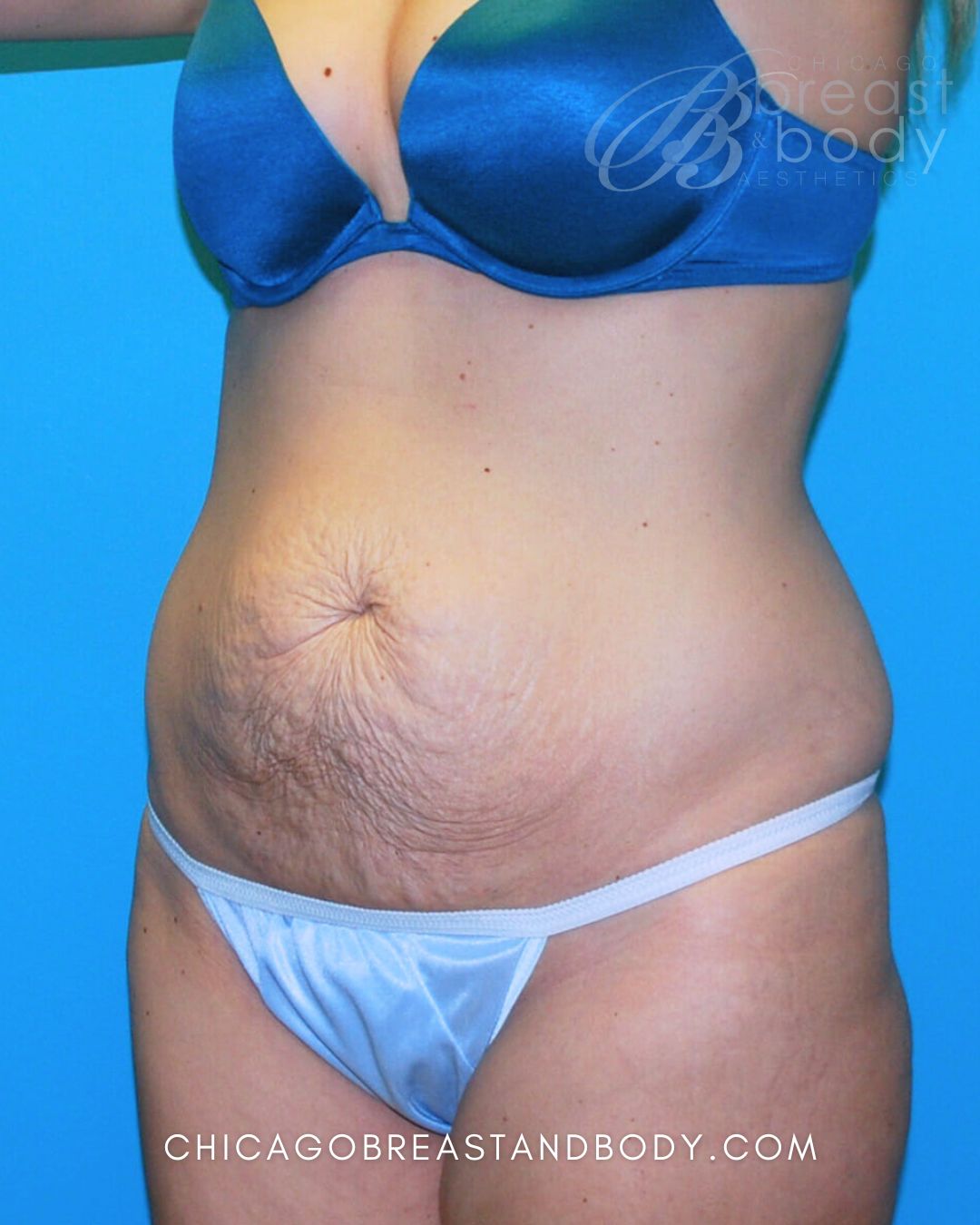 Abdominoplasty (Tummy Tuck) before photo 2, case #338, Dr. Anh-Tuan Truong, Chicago Breast & Body