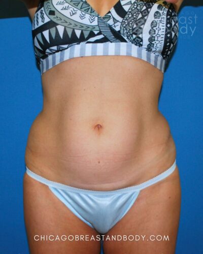 Tummy tuck before photo, case 339, actual patient of Dr. Anh-Tuan Truong in Chicago