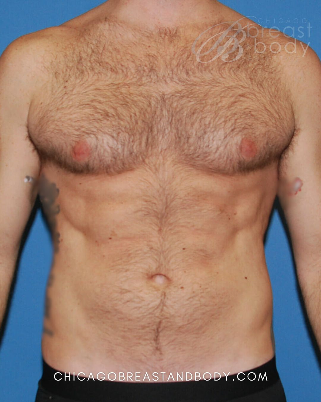 SculpSure Fat Reduction after photo 1, case #429, Chicago Breast & Body