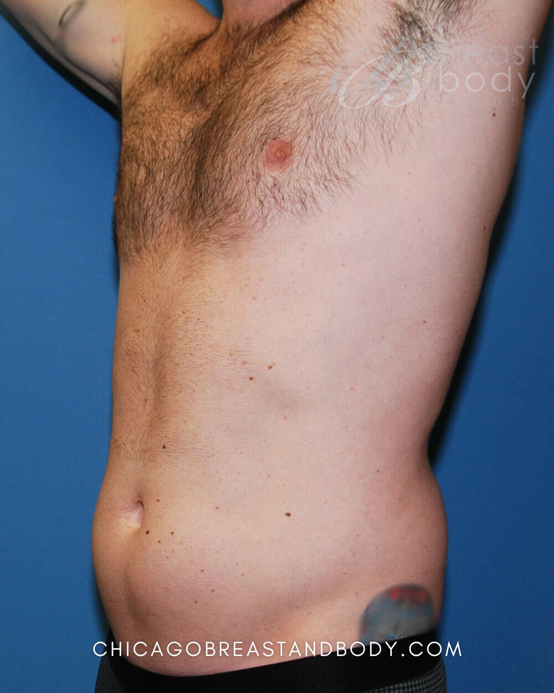 SculpSure Fat Reduction before photo 2, case #429, Chicago Breast & Body