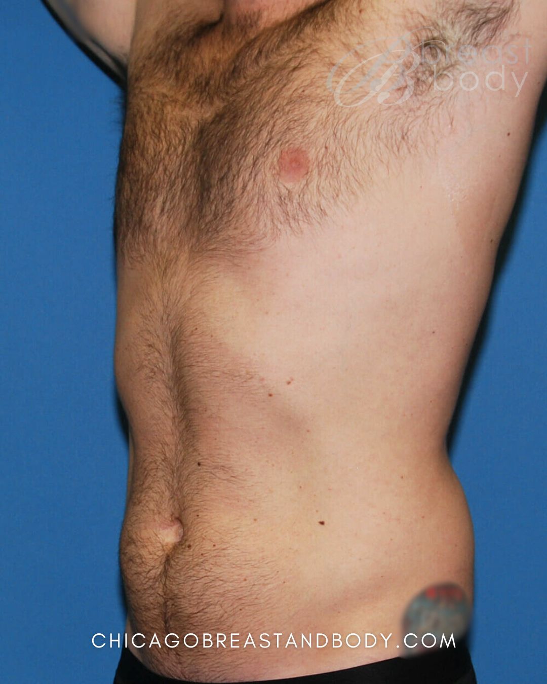 SculpSure Fat Reduction after photo 2, case #429, Chicago Breast & Body