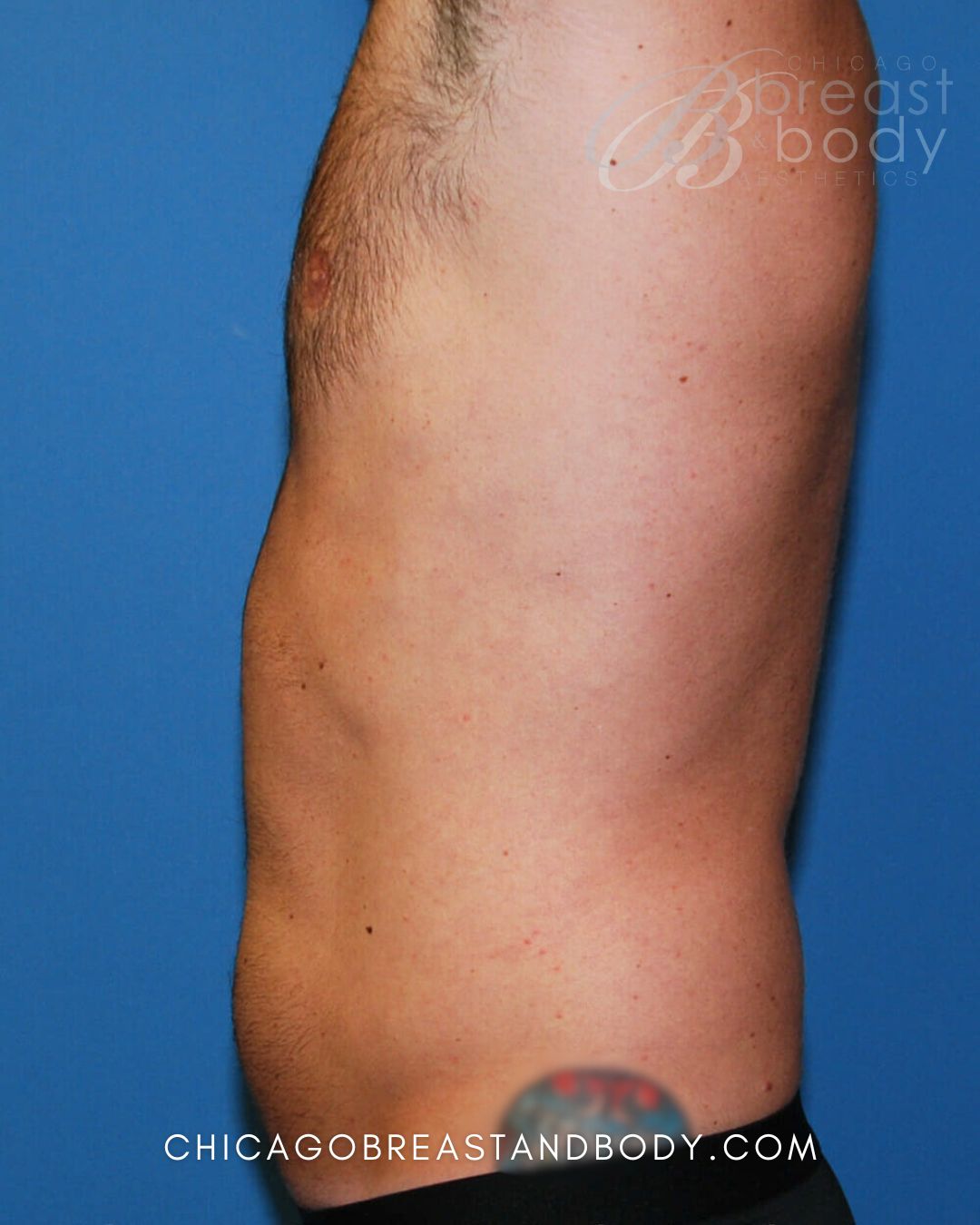 SculpSure Fat Reduction after photo 3, case #429, Chicago Breast & Body