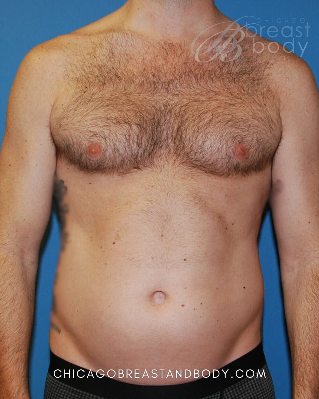 SculpSure Fat Reduction before photo 1, case #429, Chicago Breast & Body