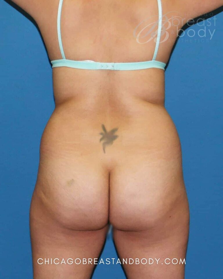 Before BBL + Lipo 360 photo, case 444, patient of Dr. Anh-Tuan Truong, back view
