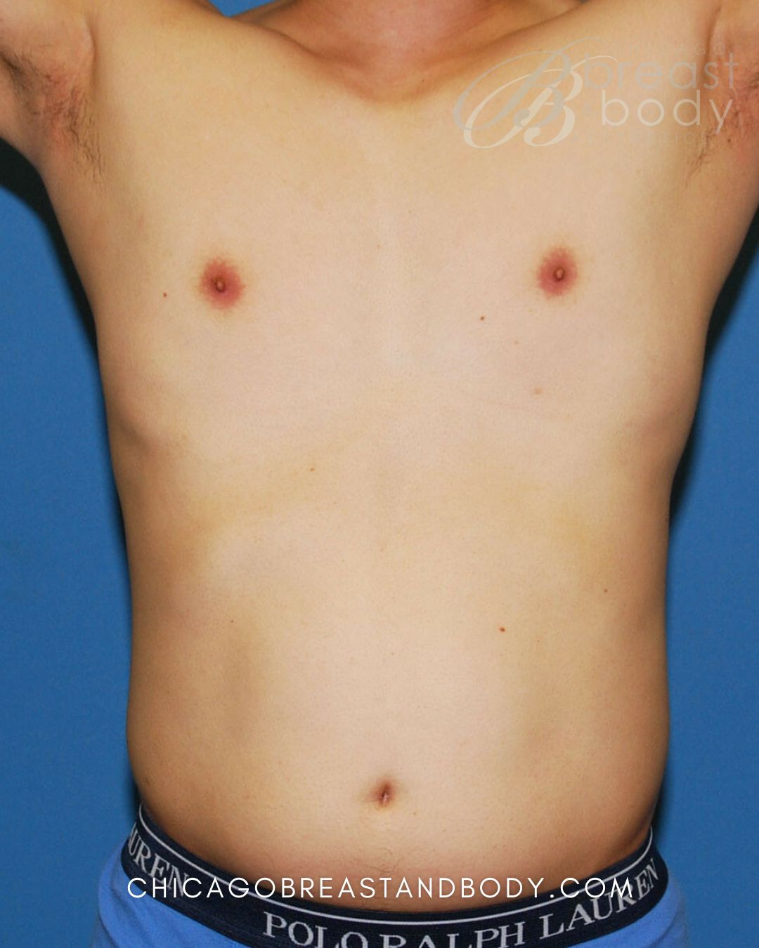 SculpSure Fat Reduction before photo 2, case #449, Chicago Breast & Body