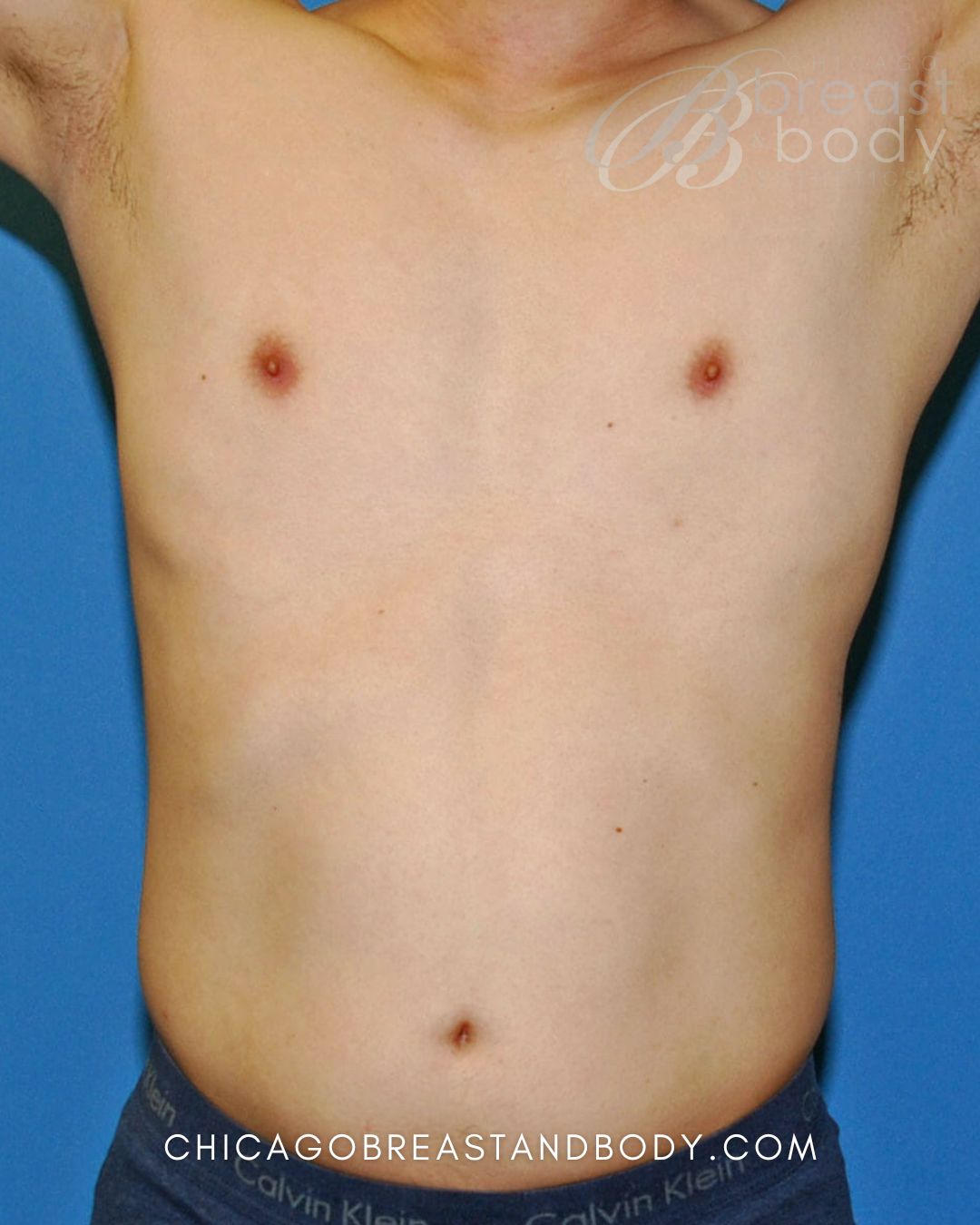 SculpSure Fat Reduction after photo 2, case #449, Chicago Breast & Body