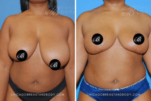 503 Breast Reduction Dr. Kevin Lin Chicago 1yr