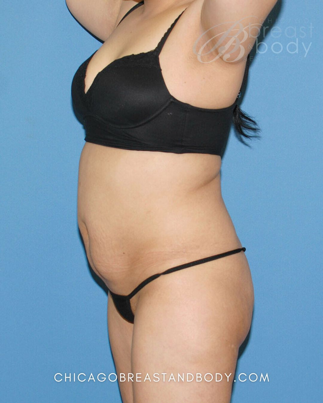 Brazilian Butt Lift, Lipo 360, Liposuction before photo 2, case #512, Dr. Anh-Tuan Truong, Chicago Breast & Body