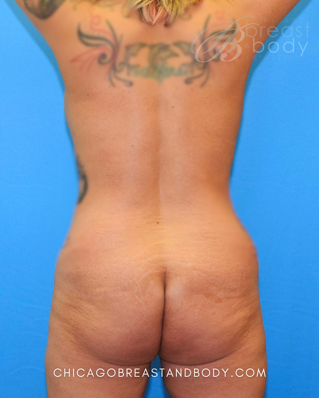 Brazilian Butt Lift, Lipo 360, Liposuction before photo 2, case #555, Dr. Anh-Tuan Truong, Chicago Breast & Body