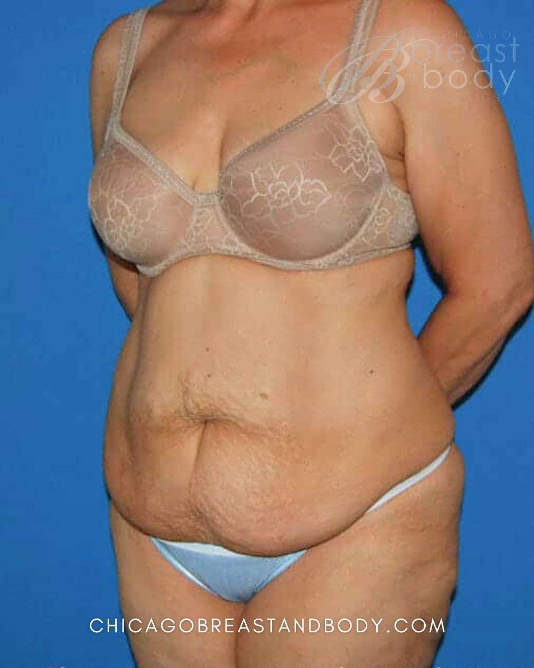 Abdominoplasty (Tummy Tuck), Plus Size Tummy Tuck before photo 2, case #60, Dr. Anh-Tuan Truong, Chicago Breast & Body