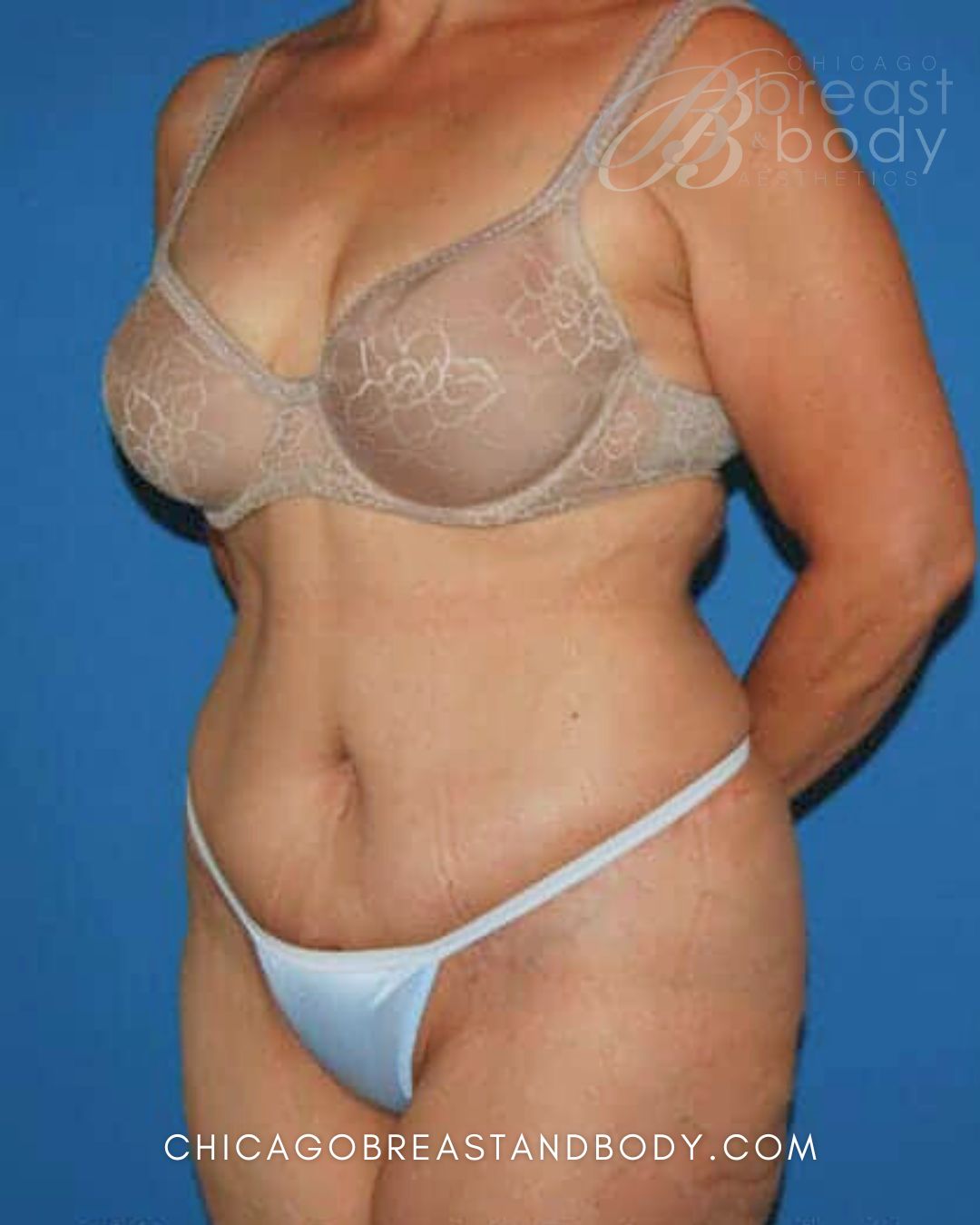 Abdominoplasty (Tummy Tuck), Plus Size Tummy Tuck after photo 2, case #60, Dr. Anh-Tuan Truong, Chicago Breast & Body