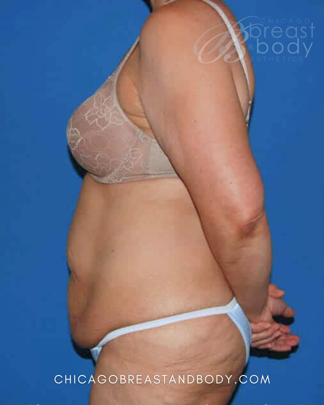 Abdominoplasty (Tummy Tuck), Plus Size Tummy Tuck before photo 3, case #60, Dr. Anh-Tuan Truong, Chicago Breast & Body