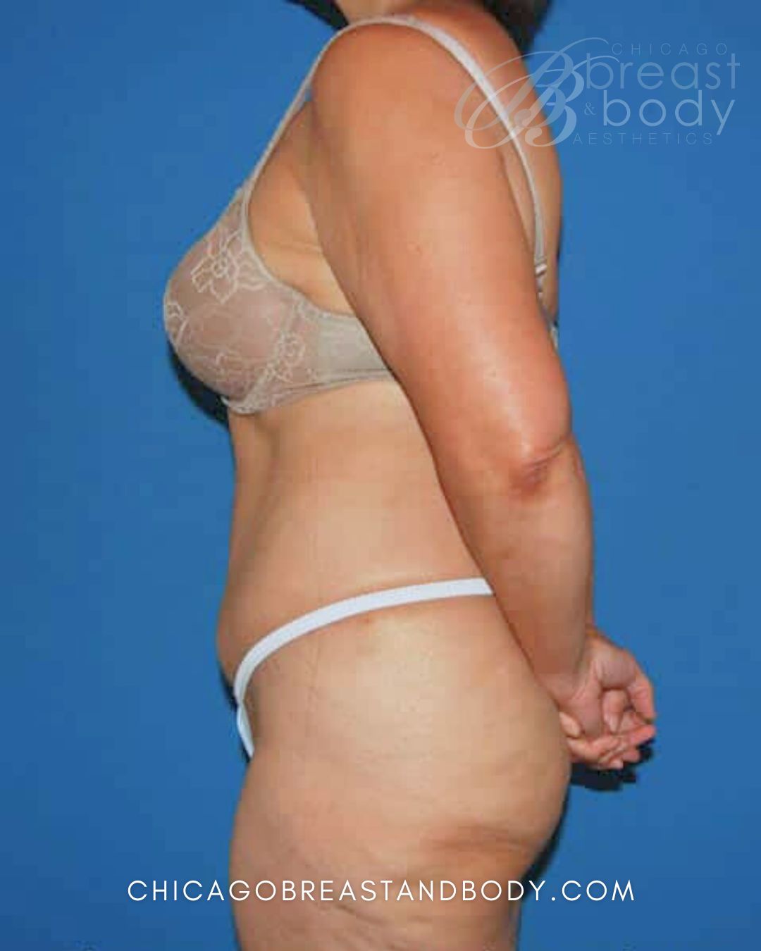 Abdominoplasty (Tummy Tuck), Plus Size Tummy Tuck after photo 3, case #60, Dr. Anh-Tuan Truong, Chicago Breast & Body