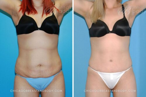 6242 Tummy Tuck Dr. Anh-Tuan Truong Chicago