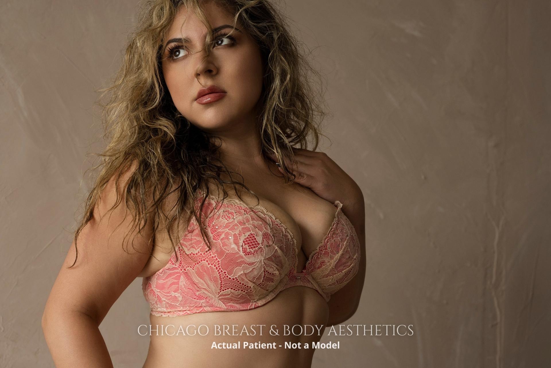 Actual Patient Following Fat Transfer To Breast Procedure By Dr. Anh-Tuan Truong