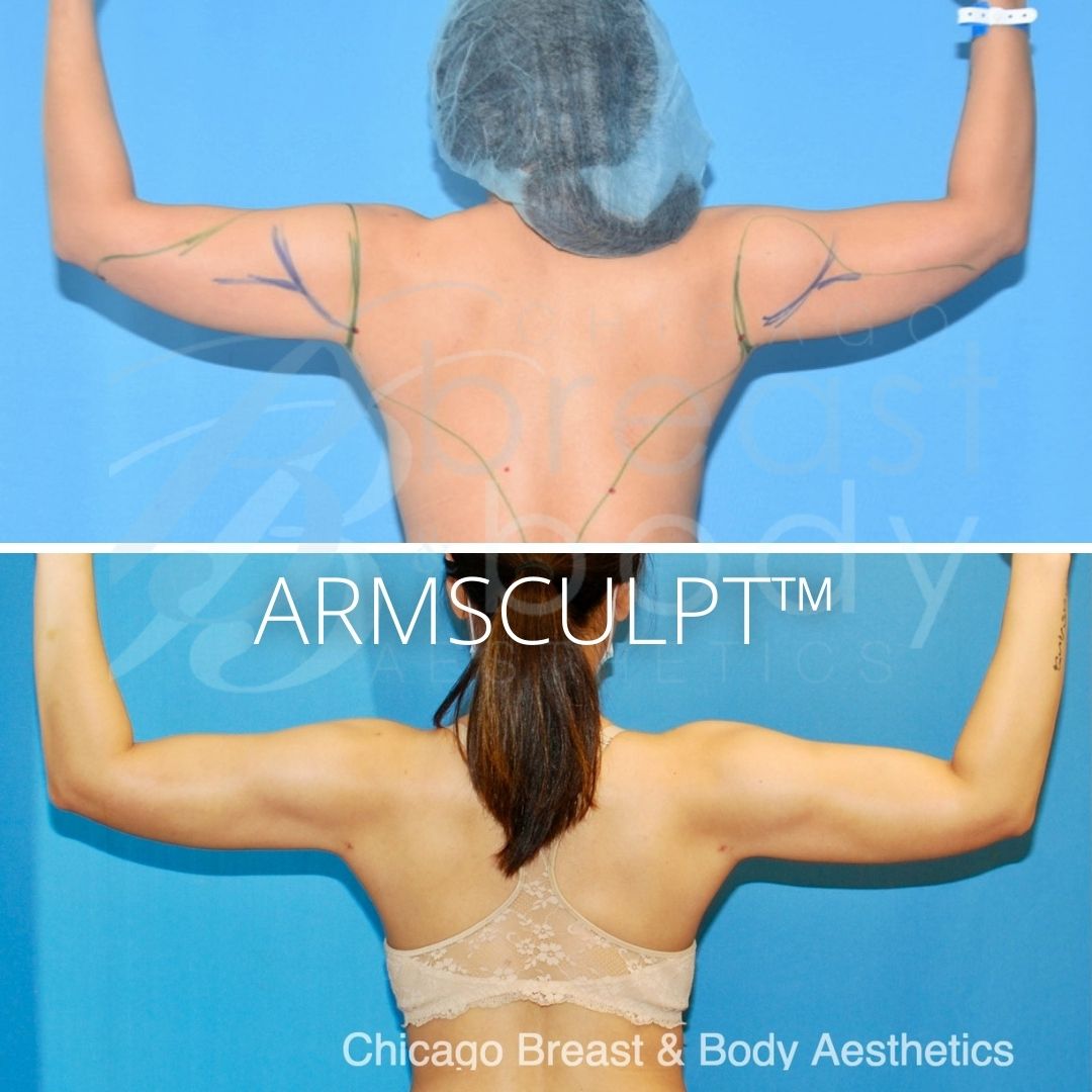Armsculpt Arm Lipo Before After Chicago Breast And Body 2
