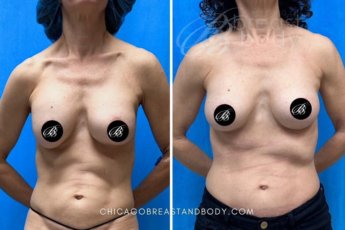 breast implant removal before after chicago breast and body 2182527