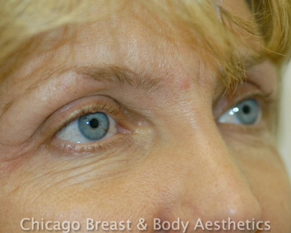 Blepharoplasty before photo 2, case #169, Dr. John Rachel, Chicago Breast & Body