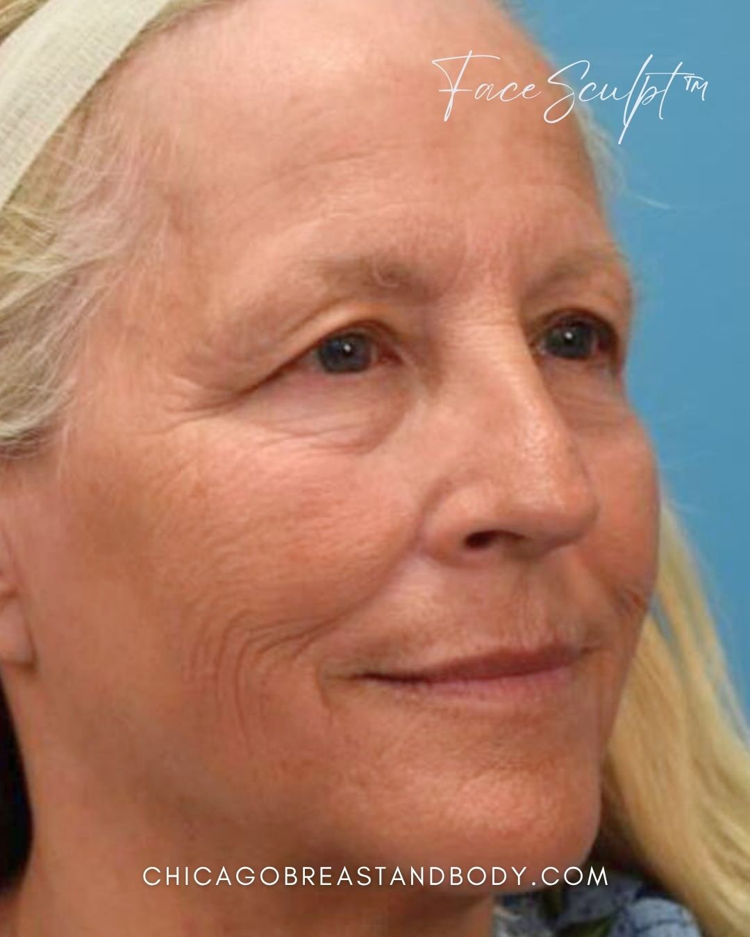 Blepharoplasty before photo 2, case #0104253, Dr. John Rachel, Chicago Breast & Body