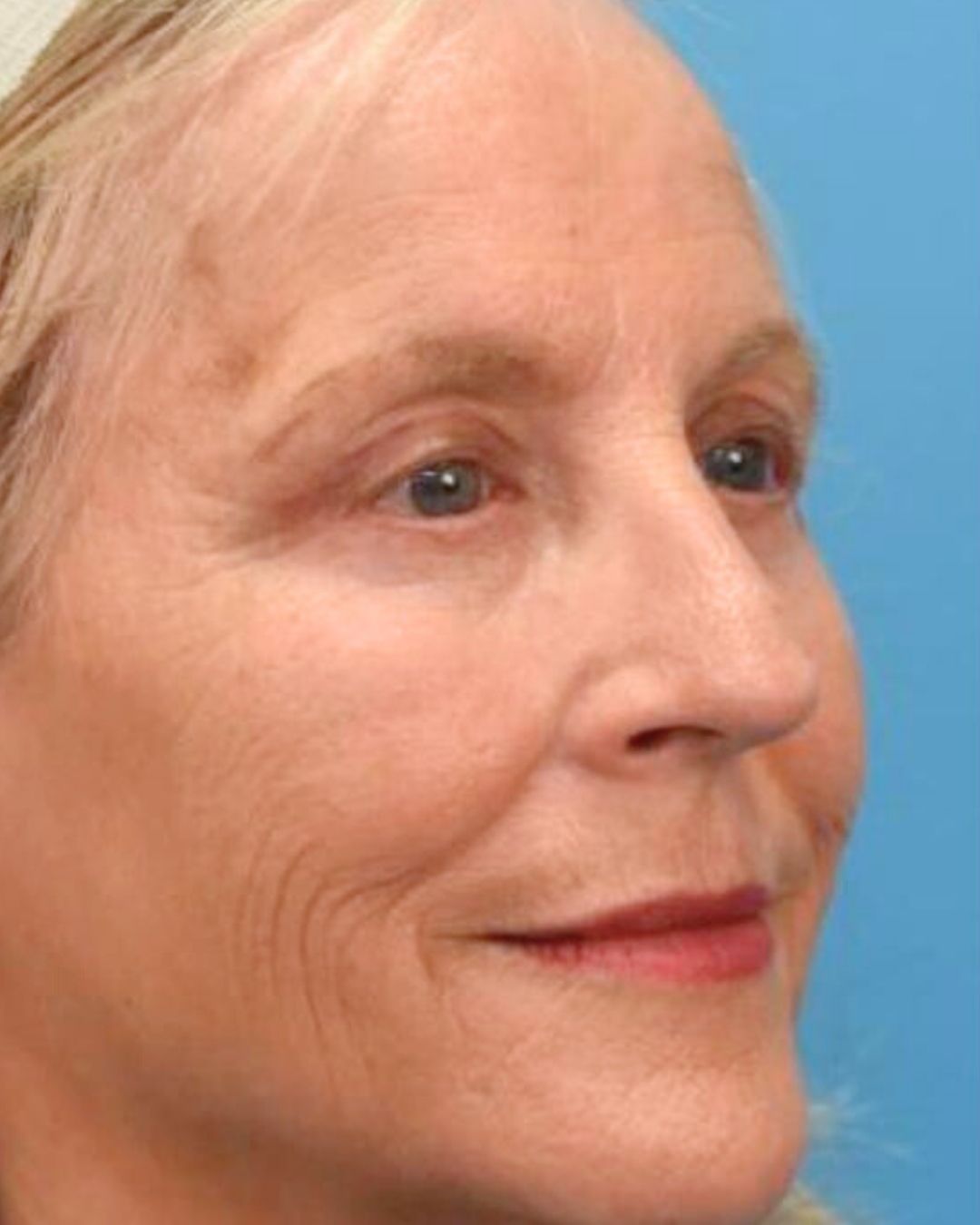 Blepharoplasty after photo 2, case #0104253, Dr. John Rachel, Chicago Breast & Body