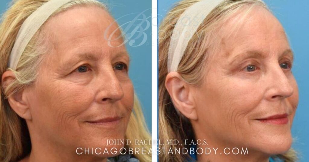 0104253 Upper Lower Bleph by Dr. John Rachel Chicago