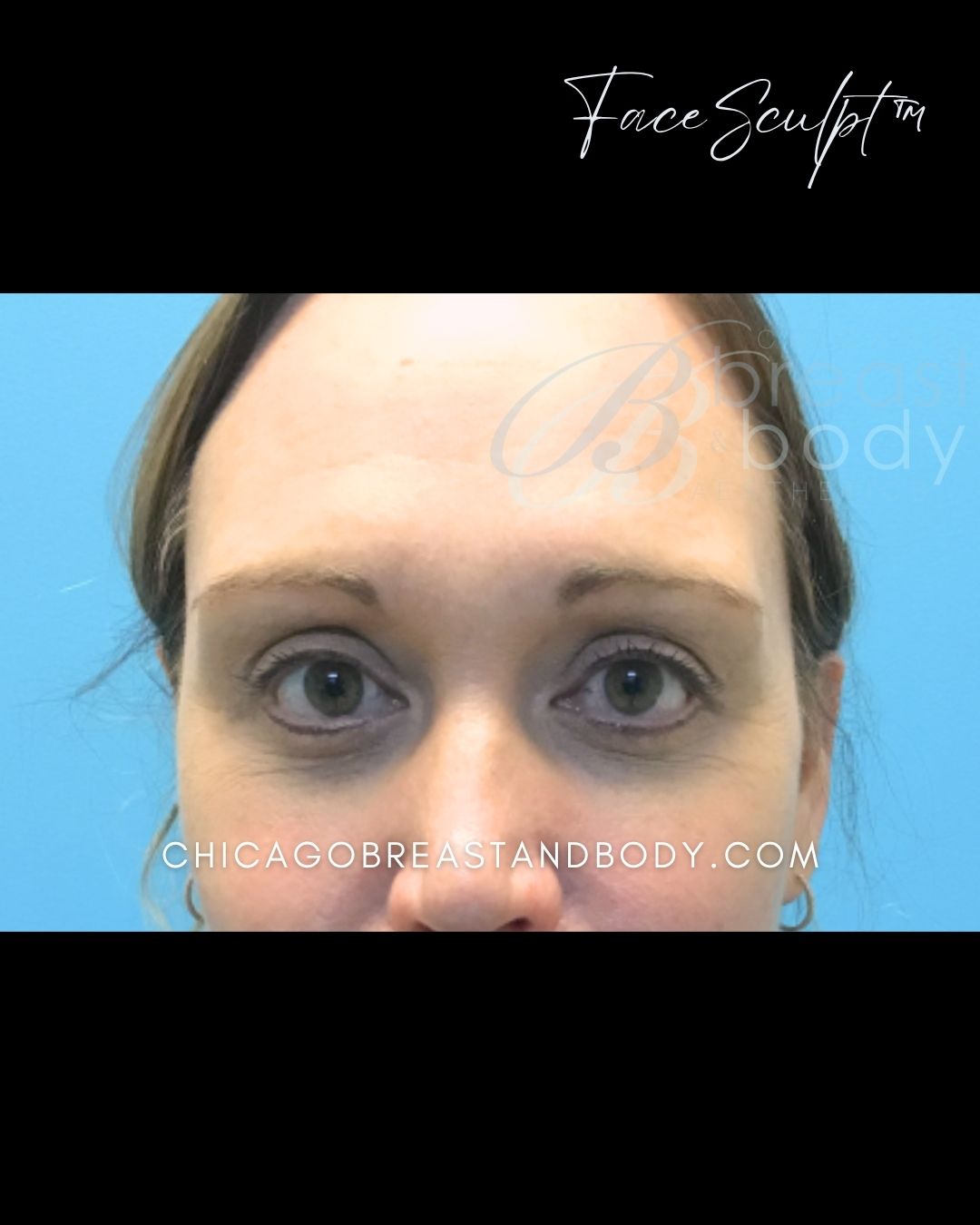 Blepharoplasty after photo 2, case #07248, Dr. John Rachel, Chicago Breast & Body