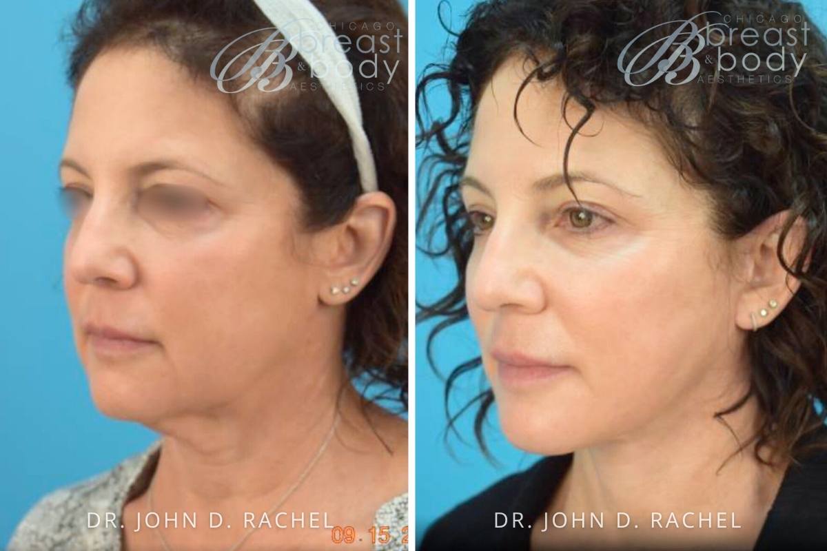 1019241 Mini Facelift before after by Dr. John Rachel Chicago breast and body