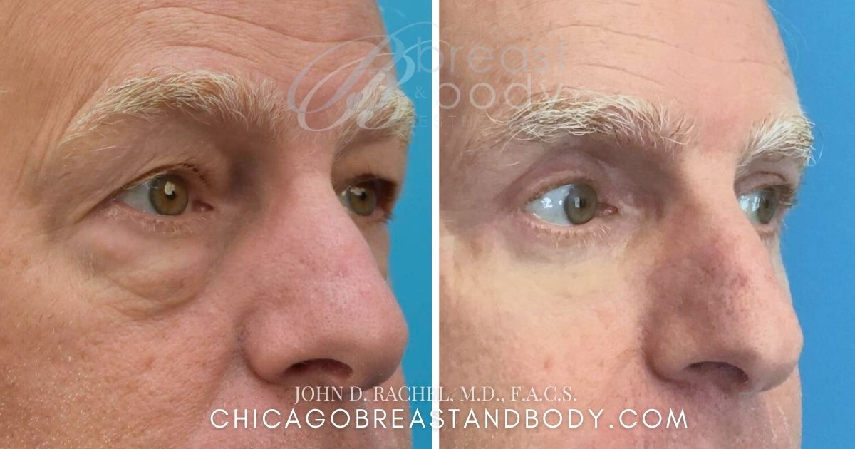1122241 Male Lower Blepharoplasy By Dr. John Rachel Chicago Breast And Body