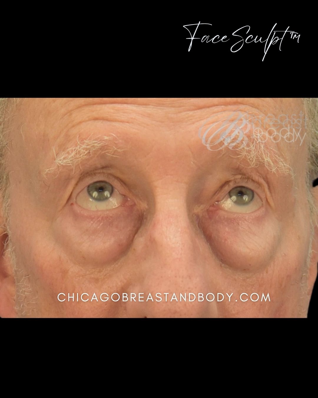 Blepharoplasty before photo 2, case #112241, Dr. John Rachel, Chicago Breast & Body
