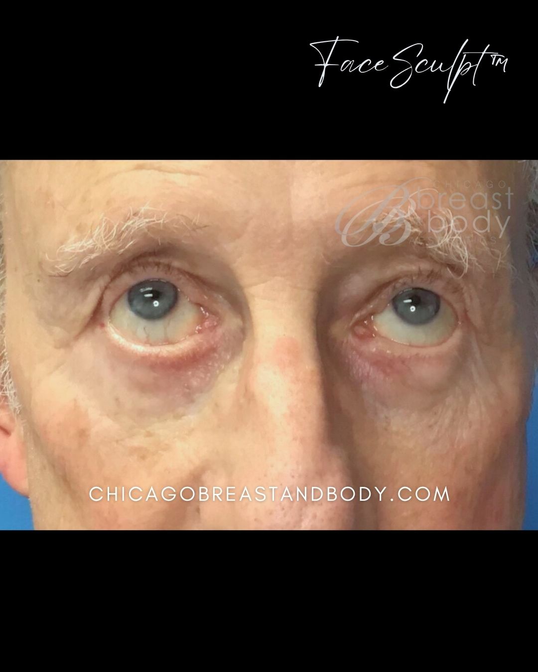 Blepharoplasty after photo 2, case #112241, Dr. John Rachel, Chicago Breast & Body