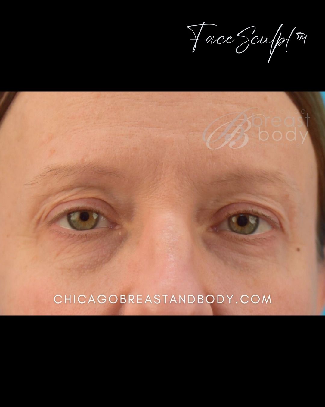 Blepharoplasty before photo 2, case #114243, Dr. John Rachel, Chicago Breast & Body