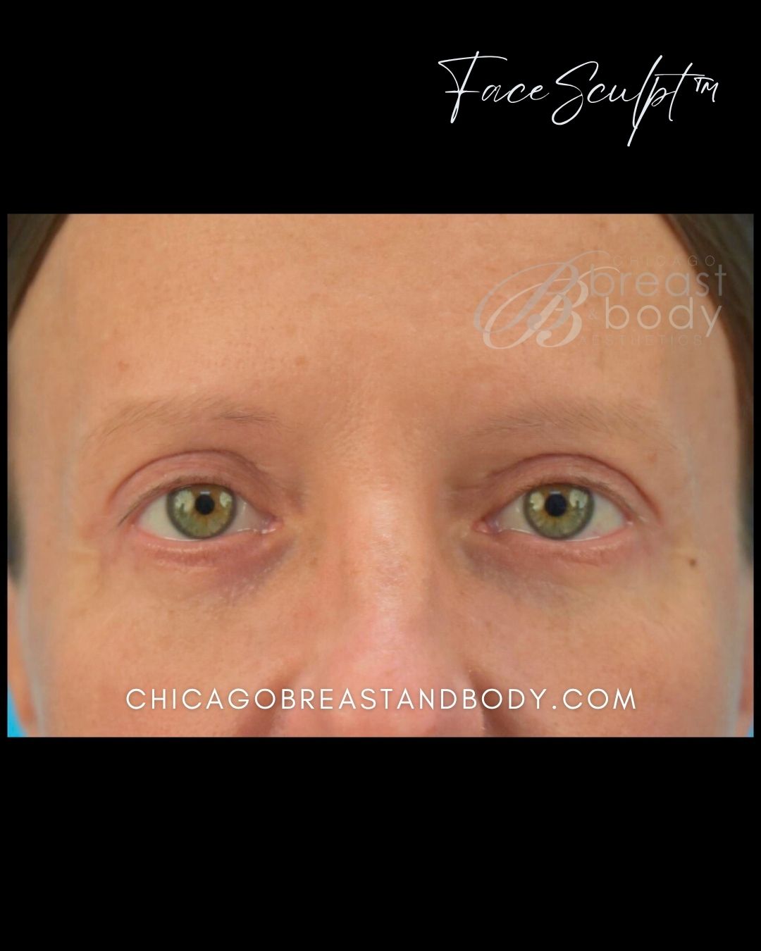 Blepharoplasty after photo 2, case #114243, Dr. John Rachel, Chicago Breast & Body