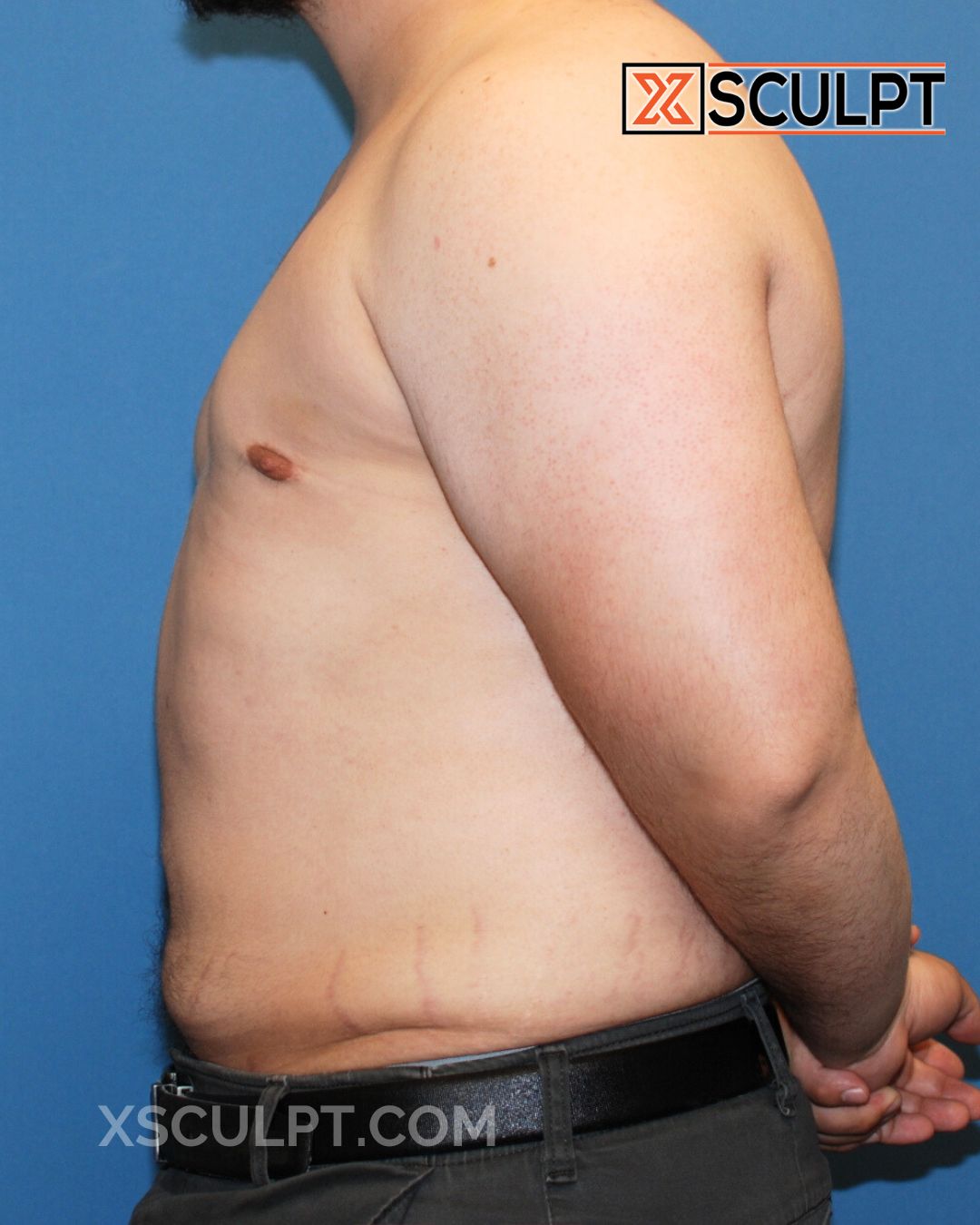 Gynecomastia ChestSculpt™ - Grade 1, Male Breast Reduction, VASER Lipo after photo 3, case #1220290, Dr. Marc Adajar, Chicago Breast & Body